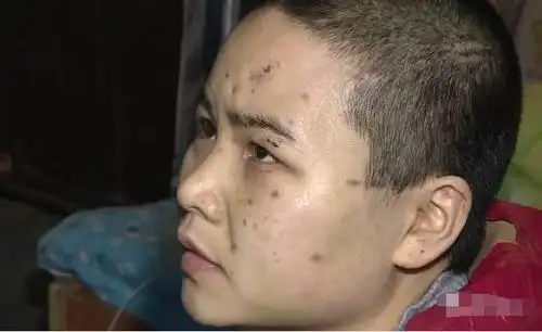 长沙一女子头部中枪,残留18颗钢珠,凶手竟是.