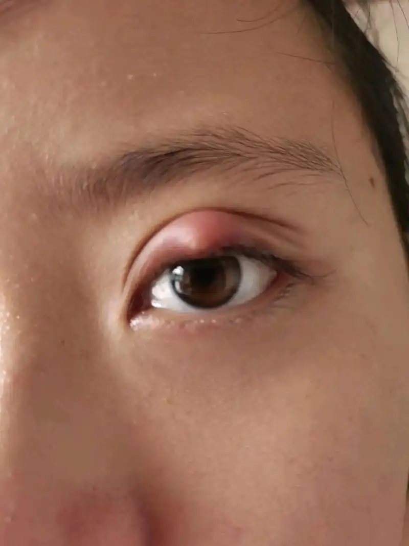 姑娘眼睑上长了个疙瘩,医生建议手术,哪个大神可以告诉我这有没有必要