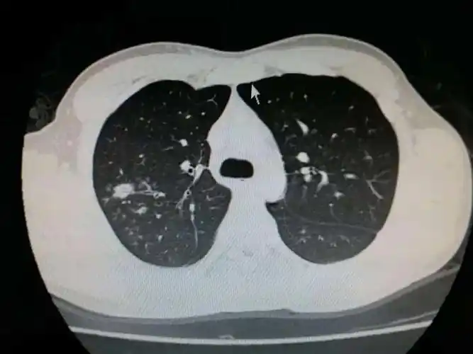 儿童肺炎(支原体肺炎)