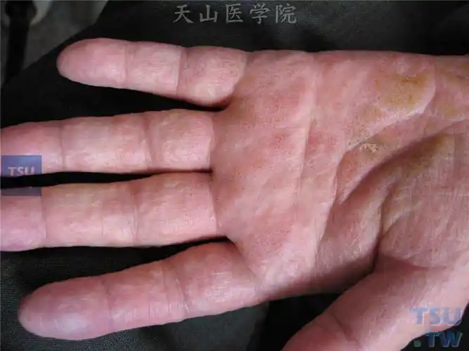 癣菌疹dermatophytid的症状表现