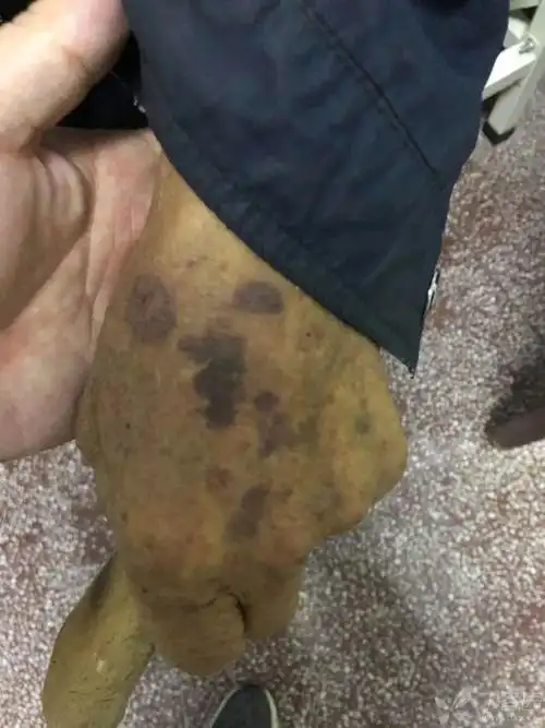 臀部皮肤现大片瘀斑,这是「屁股中毒了」?|手背|凝血_网易订阅