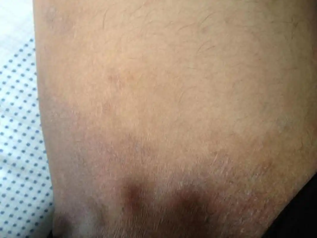 【患者提问】女生的大腿根部的腹股沟变黑是为什么?