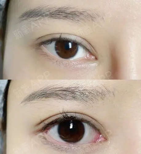 眼部多项这个是相对而说的,一般包括内眼角,下眼睑,下置,外眼角,去皮