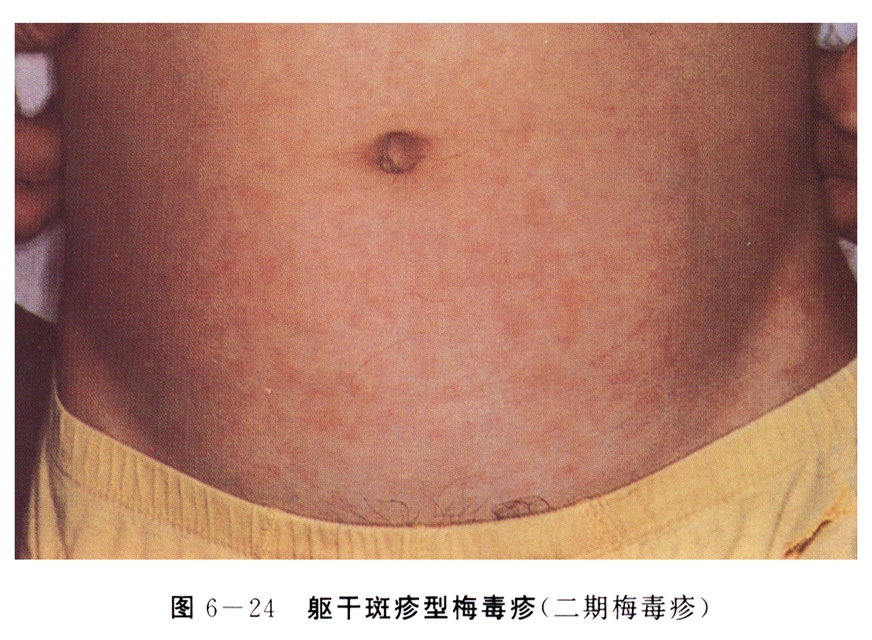 性病科普:得了梅毒多可怕?(有图,慎点)