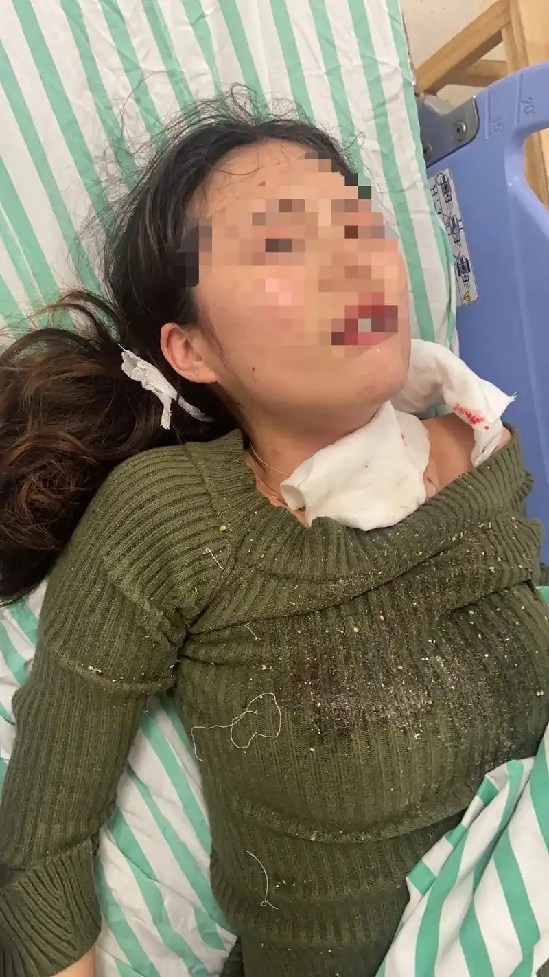 卡式炉爆炸受伤