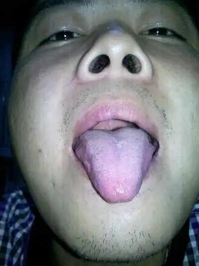 艾滋病舌头图片 (56)