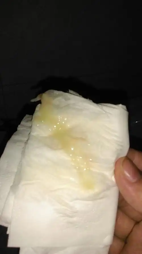 排卵期白带有血!白带浅褐色.有图慎入.