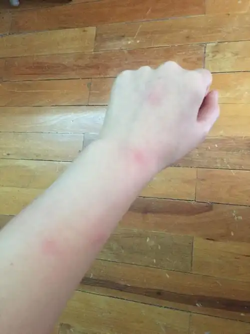 6个疙瘩.很痒 ,消下去很慢,是螨虫咬的么?还是湿疹?