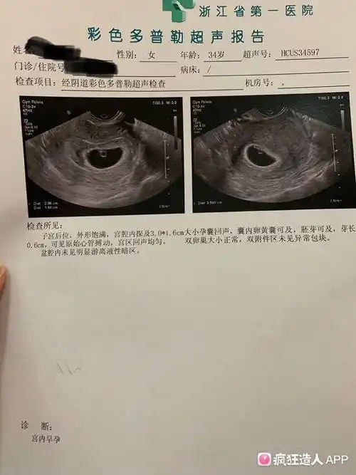 还愿,46天见胎心胎芽