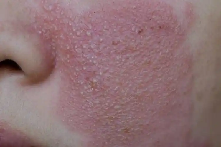 慢性接触性皮炎苔藓样皮损图