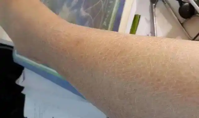 多表现为小腿至足背出现红斑,胫前弥漫水肿,进一步发展为象皮腿,疣样