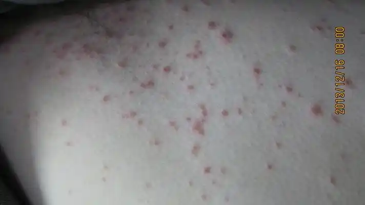 疥疮结节图片 (7)