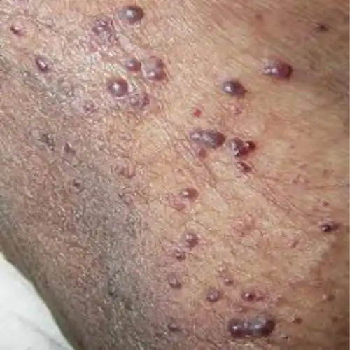 男人睾丸上的外阴湿疹图片_有来医生