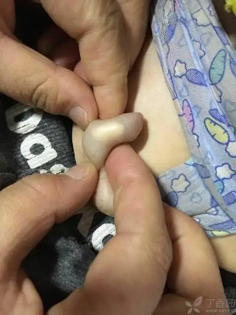 小儿阴茎病变 - 儿科专业讨论版 -丁香园论坛