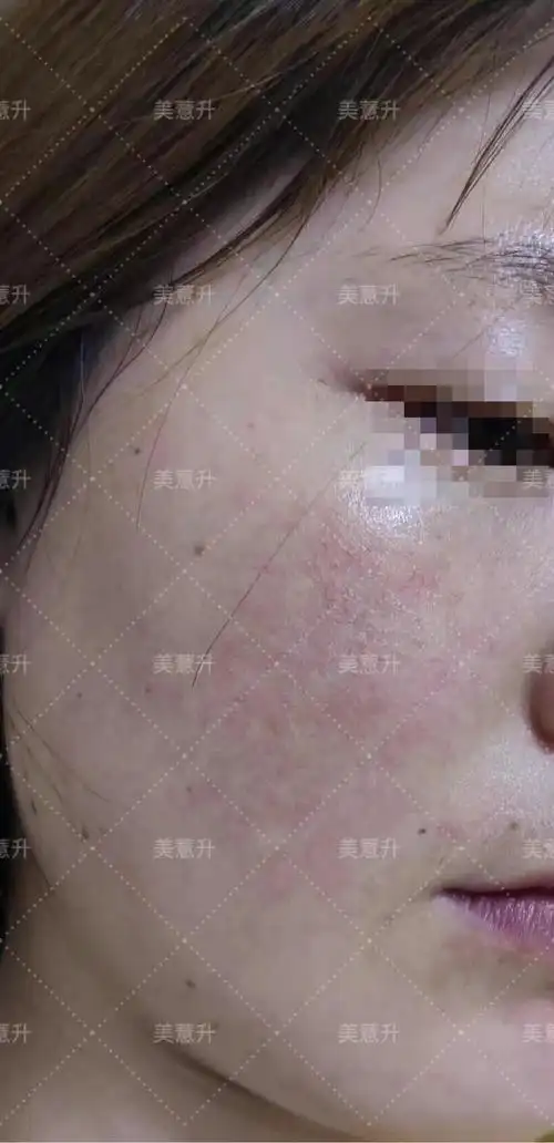 网状红血丝修复案例,为她高兴