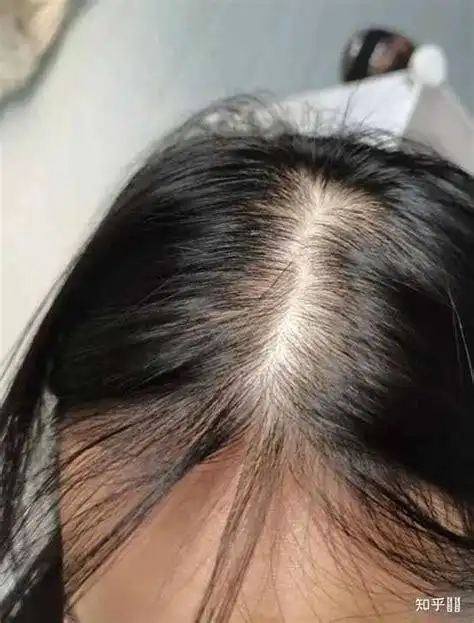 女性头顶掉发_女性头顶脱发吃什么最好 - 育儿指南