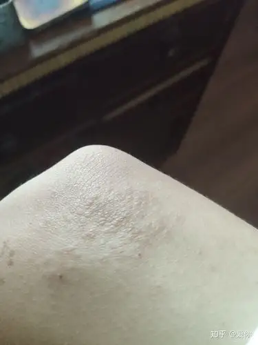 我手肘这是长了什么 - 知乎