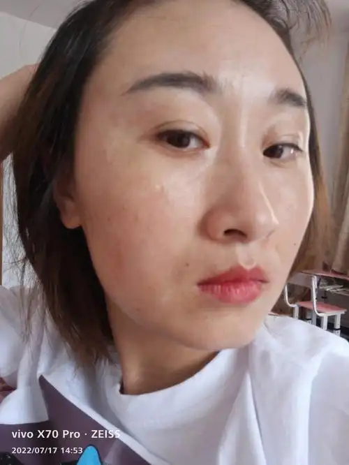 第二次光子嫩肤第二天