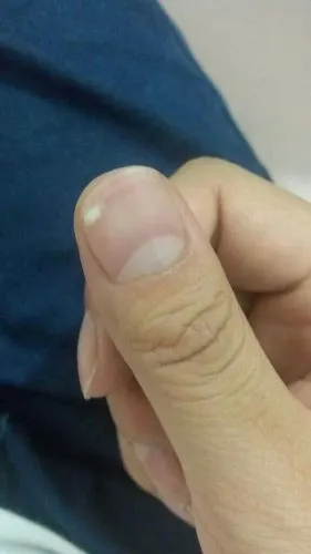 指甲上突然长了这种小白点…以前从来没有…怎么回事