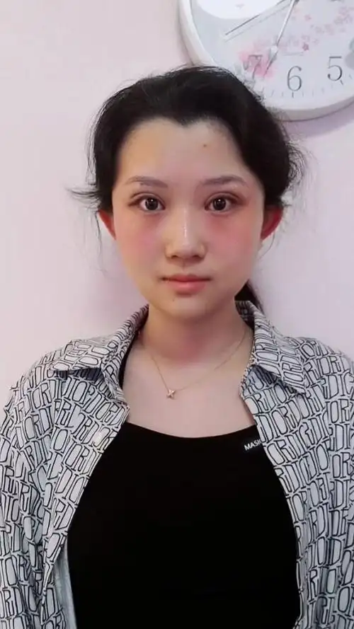 刚做的双眼皮,很漂亮