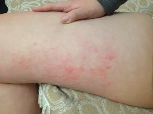 大腿内侧有一大片红,摸起来有点糙,与裤子摩擦有点疼病情描述:性别:女