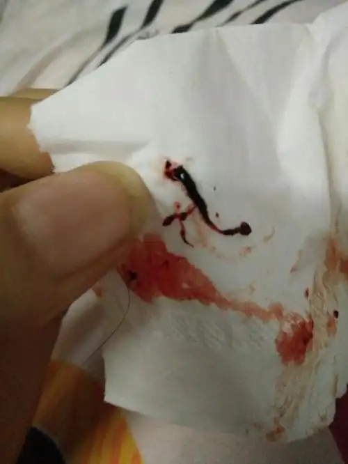 先兆流产出这样的血块 还保得住吗