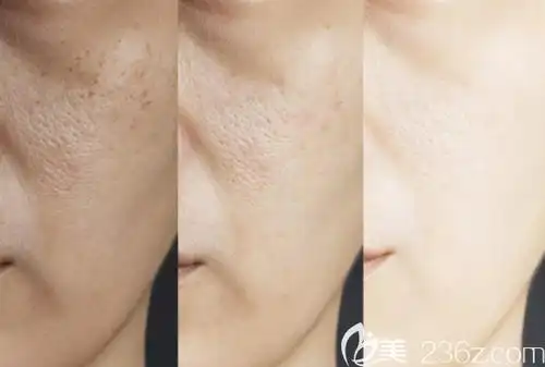 纠结微针和激光那个去痘印效果好点开这篇