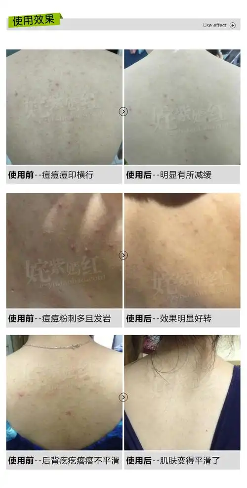 日本sana莎娜美背沐浴露300ml清爽控油去黑头去后背包包沐浴乳