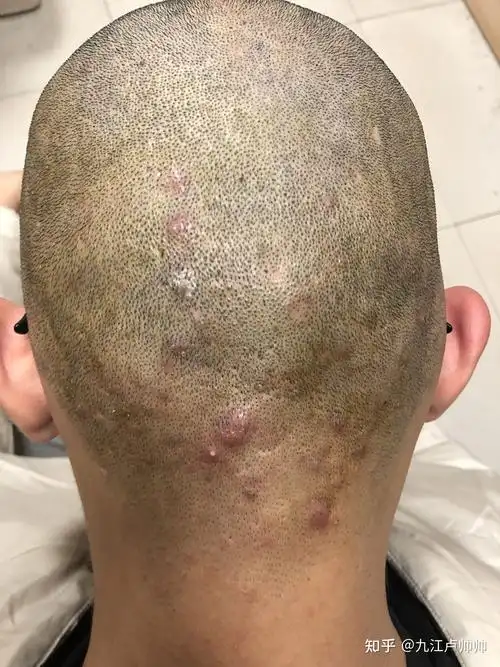 头皮毛囊炎的治疗之路!