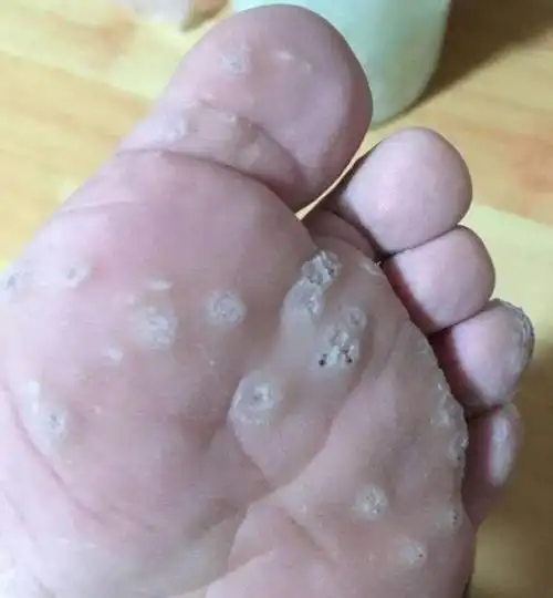 鸡眼是什么样子的图片(鸡眼) - 赤虎壹号