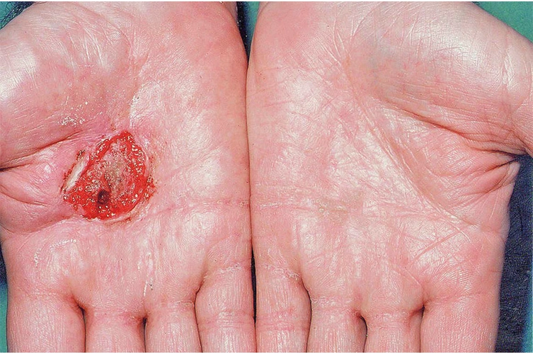 nejm:手掌鳞状细胞癌-病例报道