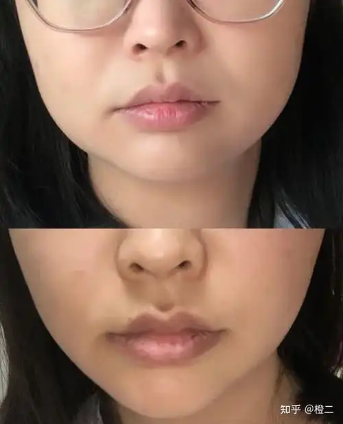 常见有四种发腮情况