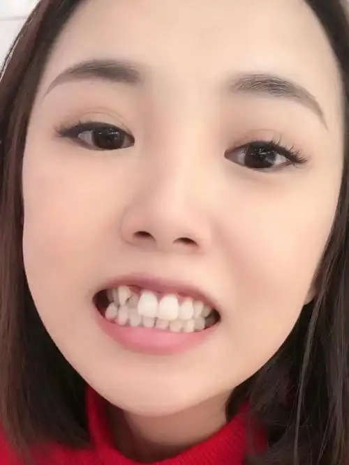 我有个牙齿长的很外面就是虎牙这颗牙搞得我嘴又凸其他_圈子-新氧美容