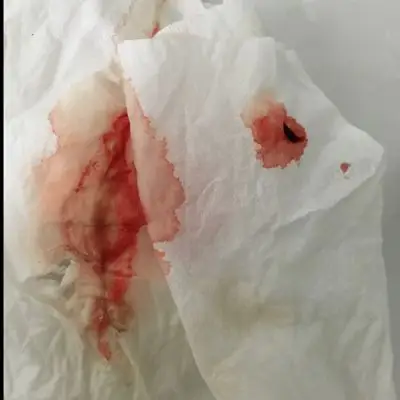 43孕6周2天2016-06-09 推荐回答                     我也出血4天了