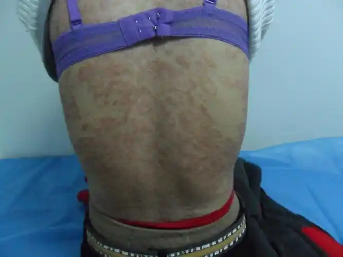 眼睑神经性皮炎图片_有来医生