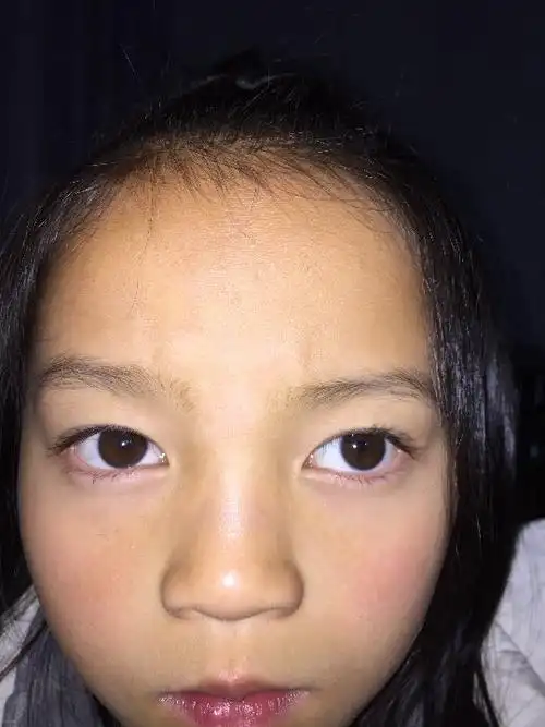 汤医生你好我是一位弱视儿童家长说起来我万分内疚女儿