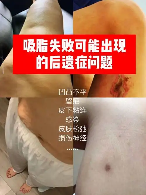 吸脂失败可能出现哪些后遗症