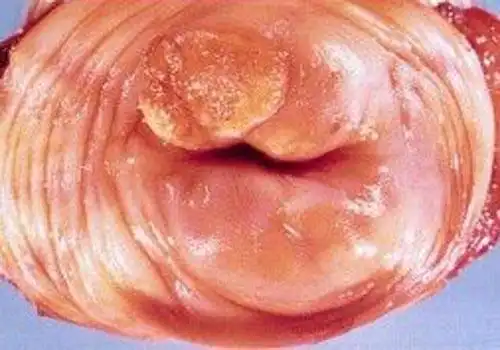 宫颈癌的早期症状