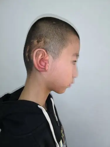 男孩,6岁,术前,右侧耳垂型小耳畸形,没有耳廓,有耳垂和部分残耳组织.