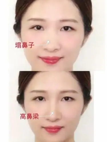 高鼻梁#鼻梁对颜值的重要性#如何拯救塌鼻梁鼻梁位_圈子-新氧美容