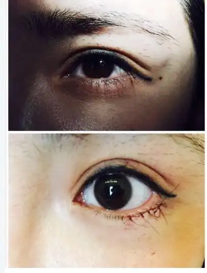 下眼睑下至内切对比