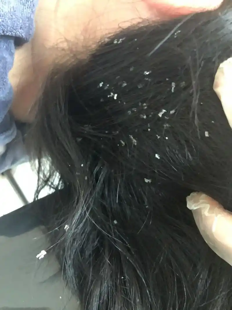 头皮屑困扰了很多年…一年到头头皮都是痒的,而且都是一大片的头 - 抖
