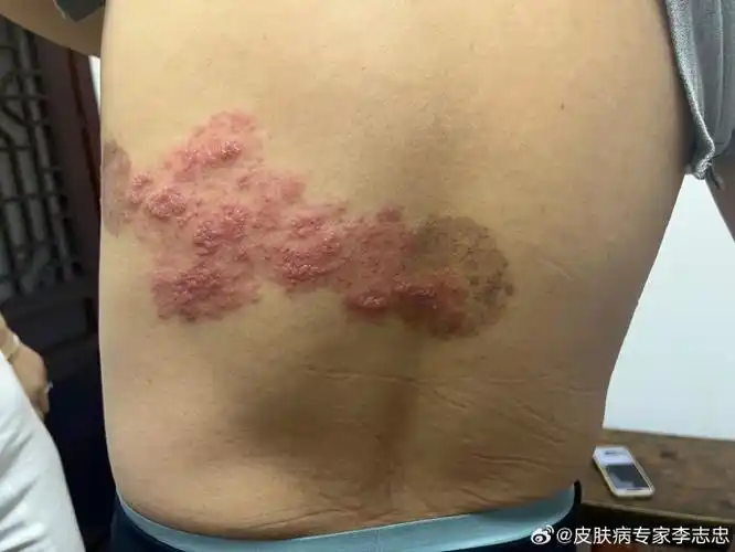 带状疱疹