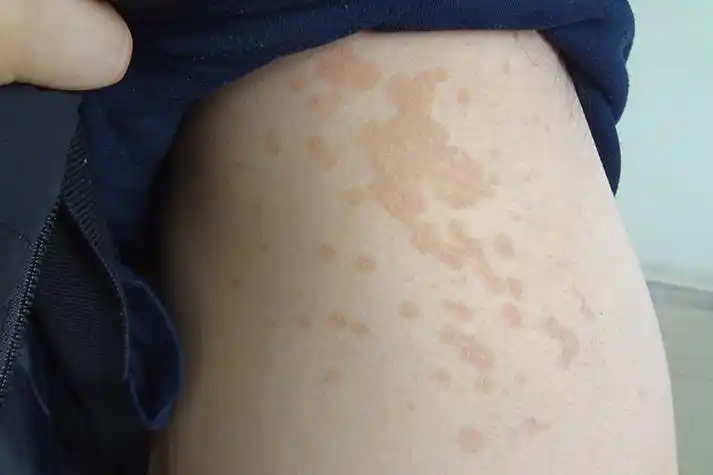 花斑糠疹斑疹图