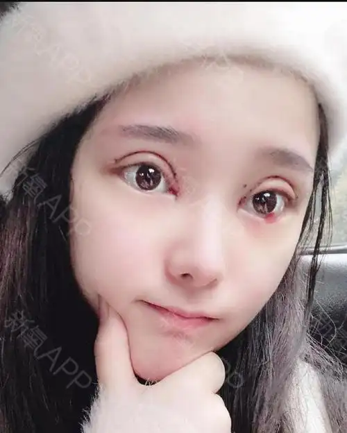 喜欢宽宽的双眼皮,所以跟医生说开的大一点,嗯,感觉还很不自然在等等.