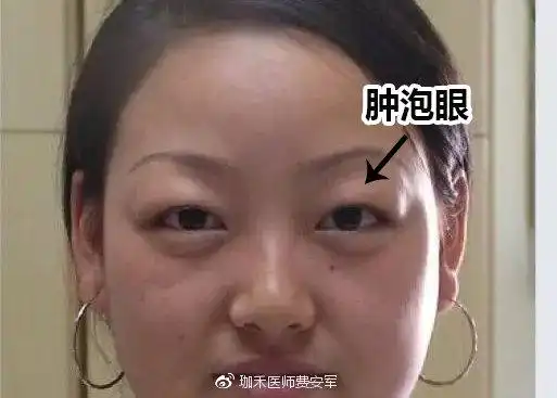 但注意,眼窝也不是填得越满越年轻,如果填充得过厚,反而会成为 肿泡眼