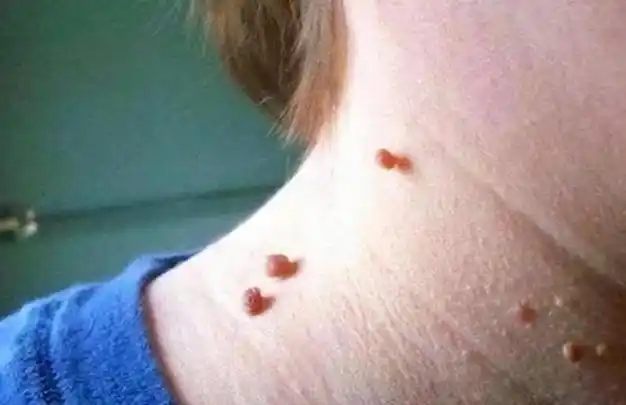 皮肤长"小肉球"是什么东西,可以抠掉吗?会是癌吗?答案在这里