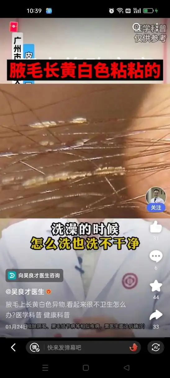 腋毛长了黄白色分泌物,腋毛藓难清洗 0378长这么大,今天第一次