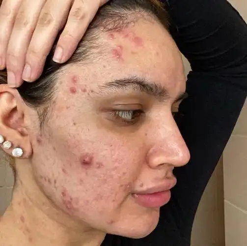 积极接受自己的皮肤状况痤疮需要被正常化看待