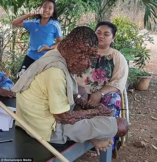 泰国男子患罕见病 全身长满泡泡状肿瘤睁眼都费劲_时讯_看看新闻